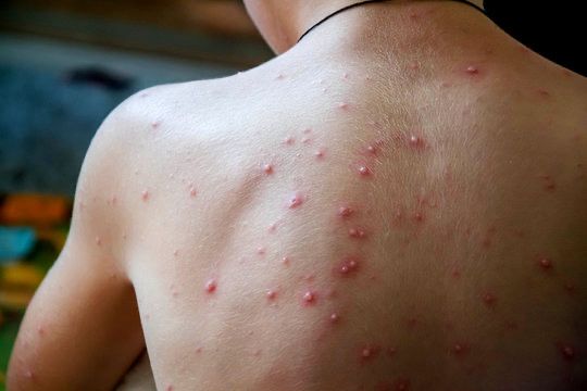 Chicken Pox